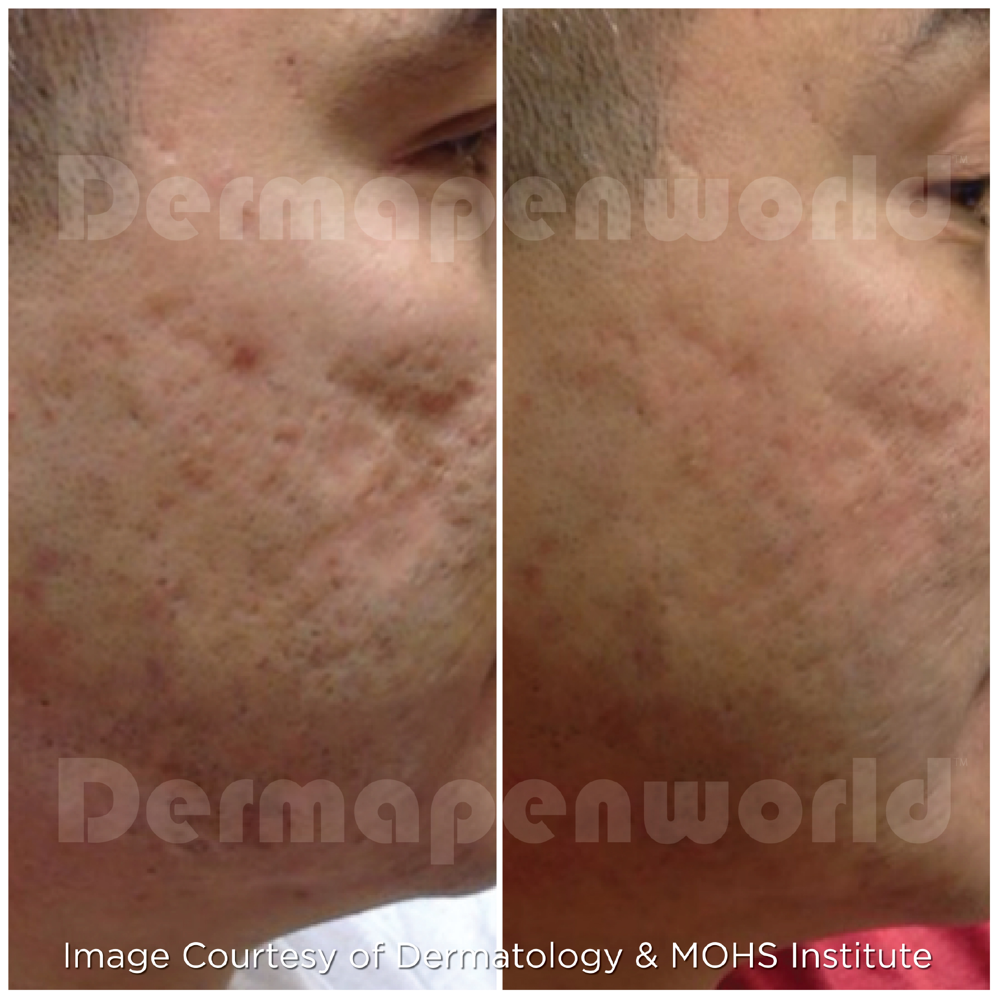 Acne Scar Male 6